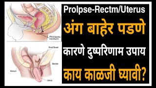 Prolapse|Rectum|Uterus अंग बाहेर पडणे कारणे दुष्परिणाम उपाय,काय काळजी घ्यावी?/502/Dr Ram Jawale