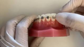 How to close a bracket clip