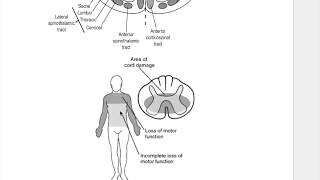 CENTRAL CORD SYNDROME