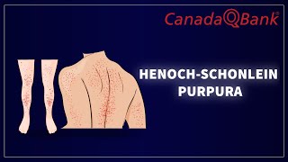 Henoch Schonlein Purpura