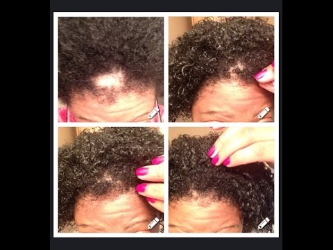 How To Hide A Bald Spot Hair Bald Spot Cover