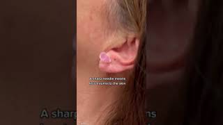 Piercing after earlobe repair | 208SkinDoc