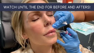 Volbella Lip Filler With Before and After Photos