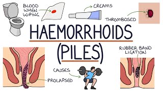 Understanding Haemorrhoids