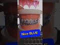 Nice BLUE for braces