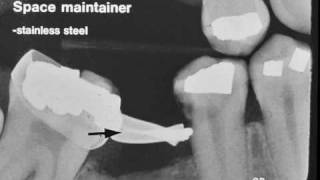 Dental Radiograph Pathology & Restorations :: Part 2