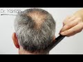 dr resul yaman hair clinic 5220 grafts 12 months before after result hair transplant