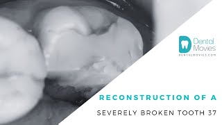 Reconstruction of a severely broken tooth 37