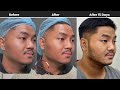 Facial Harmony for men: nose, chin and jawline enhancement | Dr. Contessa Salvador - Alapag