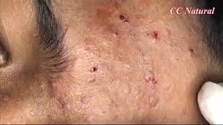 Facial Acne Treatment | Blackheads Extraction on Face | Acne Removal #65