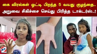 கை விரல்கள் ஓட்டி பிறந்த 5 வயது குழந்தை..அறுவை சிகிச்சை செய்து பிரித்த டாக்டர்ஸ்..!