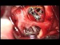 ANTERIOR CEREBRAL ARTERY ANEURYSM-ACA-A1 -dr suresh dugani/SDM MEDICAL COLLEGE /DHARWAR/INDIA