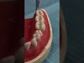 tooth prep for a lower premolar crown dentalshorts dentalcrowns dentaleducation