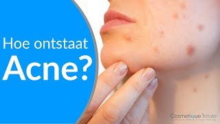 WAT IS ACNE, HOE ONTSTAAT ACNE en hoe kan je acne voorkomen?
