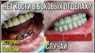 Нет кости в боковых отделах. Особо сложный случай.