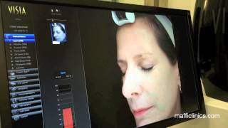 Maffi Clinics: VISIA Skin Analysis