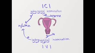 What is ICI? (Intracervical insemination)