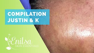 Compilation of “Justin” and “K” Blackheads Extractions