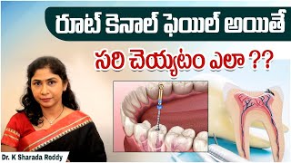 రూట్ కెనాల్ చికిత్స | Why Root Canal Treatment Fails? | Causes \u0026 Signs for RCT Failure | LBR Dental