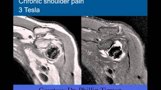 Shoulder Bones | Pt. 3 | Inflammation