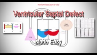 Ventricular Septal Defect (VSD) | Classification | Pathophysiology | Clinical Features | Made Easy
