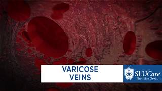 Treating Varicose Veins - SLUCare Vascular Surgery