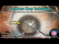 CataractCoach™ 2146: the cross chop technique