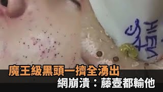 密集恐懼慎入！男子臉頰長滿黑頭粉刺　美容師一擠「啵啵啵」全湧出－全民話燒