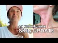 SKIN UPDATE: Feeling Discouraged // Topical Steroid Withdrawal & Eczema