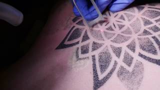 Tattooentfernung mit Laser