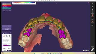 How to Use Your Wax-Up as a Pre-Op Scan in Exocad for Fast Temporary Crowns