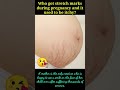 who get stretch mark during pregnancy and it used to be itchy pregnancy problem pregnancy share