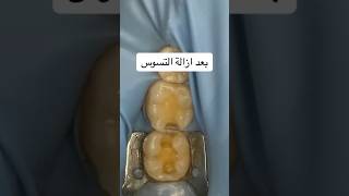 composite restoration of posterior teeth #dr_abdullah_sultan_dentist