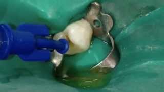 Irrigation aspiration periapical cyst