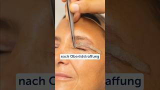 #Oberlidstraffung #LidKorrektur #oberlid #AntiAging #Operation #Ästhetik