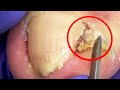 Ingrown Toenails Trimming Collection, Toenail Restoration[Doctor Liu Pedicure]