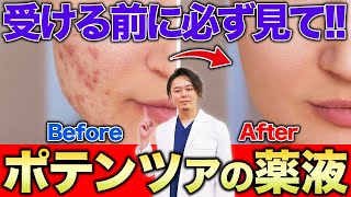 肌トラブルを全解決！？ポテンツァの効果・薬液について徹底解説