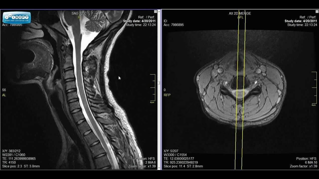 Mri Of The Cervical Spine Anatomy The Best Porn Website Mri Of The Cervical Spine Anatomy The Best Porn Website