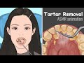 [ASMR] Tartar removal animation / Dental Scaling / Satisfying