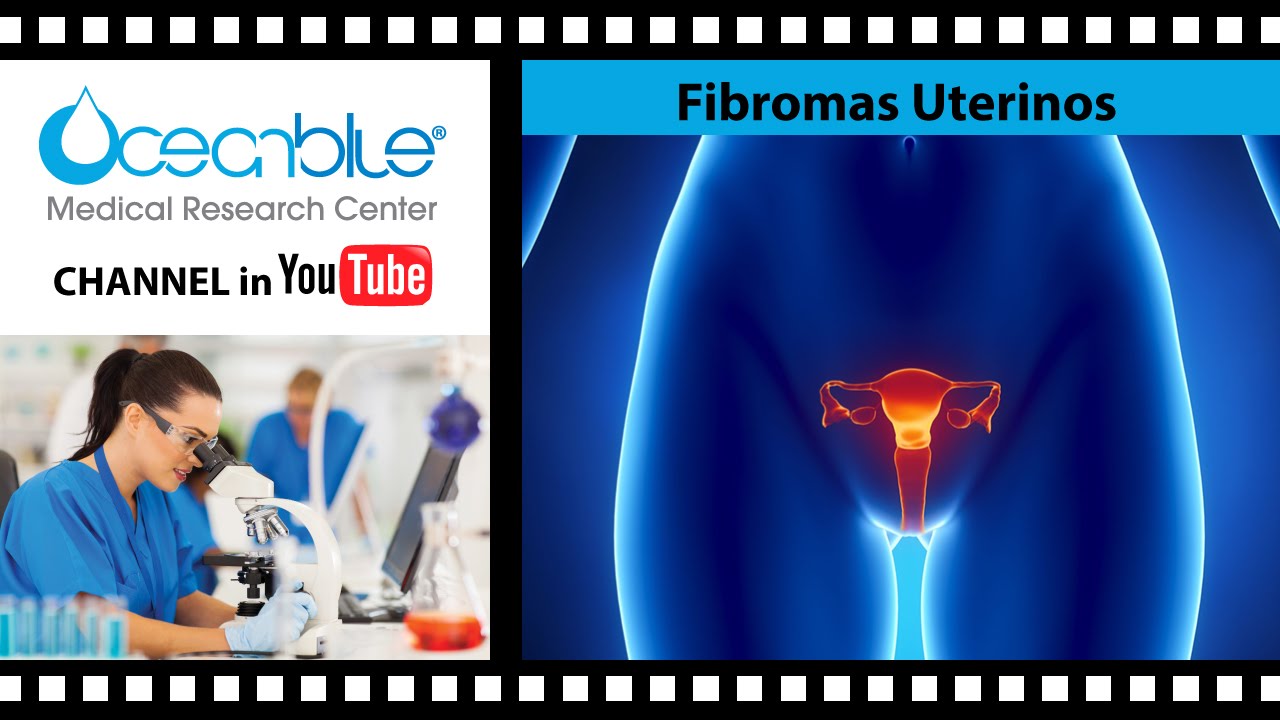 Fibromas Uterinos, Síntomas Y Causas - YouTube