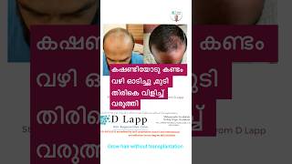 കഷണ്ടിക്കും ഇനി ബൈ പറയാം #dlapp #hairloss #baldnesstreatment #hairgrowth #hairfall #beforeandafter