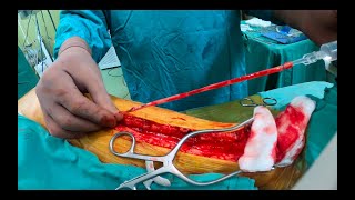 Coronary Artery Bypass: Saphenous Vein Graft Preparation and Anastomosis to PDA