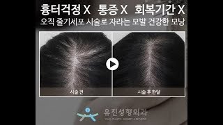 Bio-cell 줄기세포 탈모치료란?