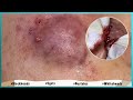 Big Cystic Acne Blackheads Extraction Blackheads & Milia, Whiteheads Removal Pimple Popping