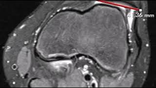 Patellar tracking disorder with lateral patellar subluxation and tilt