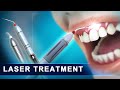 LASER DENTISTRY