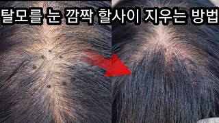 탈모를 빠르게 회복 할 수 있는 방법과 설명 /천안증모술/헤어증모술/한올재사용증모술/증모