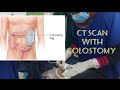 CT SCAN OF A PATIENT WITH COLOSTOMY/STOMA | RADIOGRAPHY