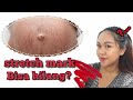 PERAWATAN MENGHILANGKAN STRETCH MARK || LOPEZ TEOPOLUZ . PART1