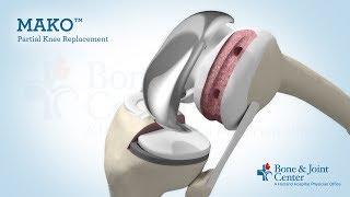 Partial Knee Replacement | Mako Robotic Arm Assisted Surgery Technology